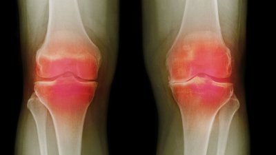 Implantet elektrike të gjurit mund të jenë zgjidhja për miliona persona që vuajnë nga artriti